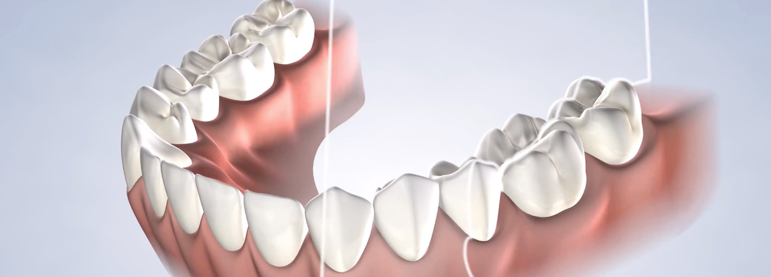 3D impresions procedure video thumb