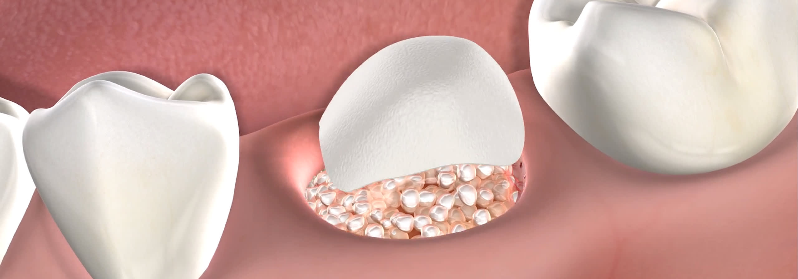 Bone grafting procedure desktop