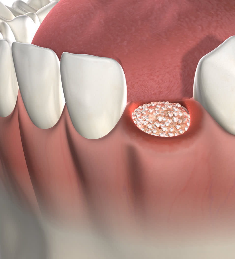 Bone graftingn procedure query page