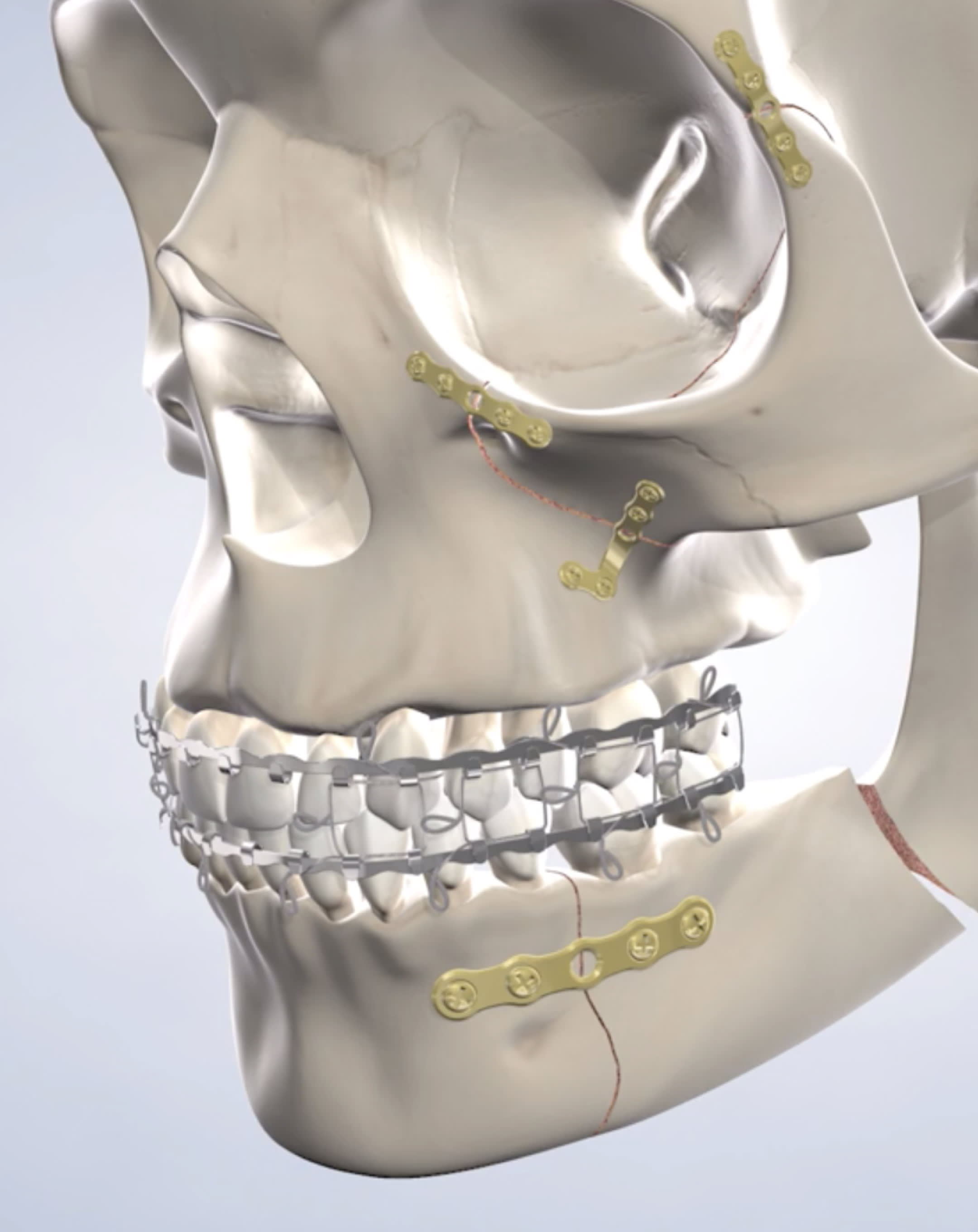 Facial trauma procedure mobile