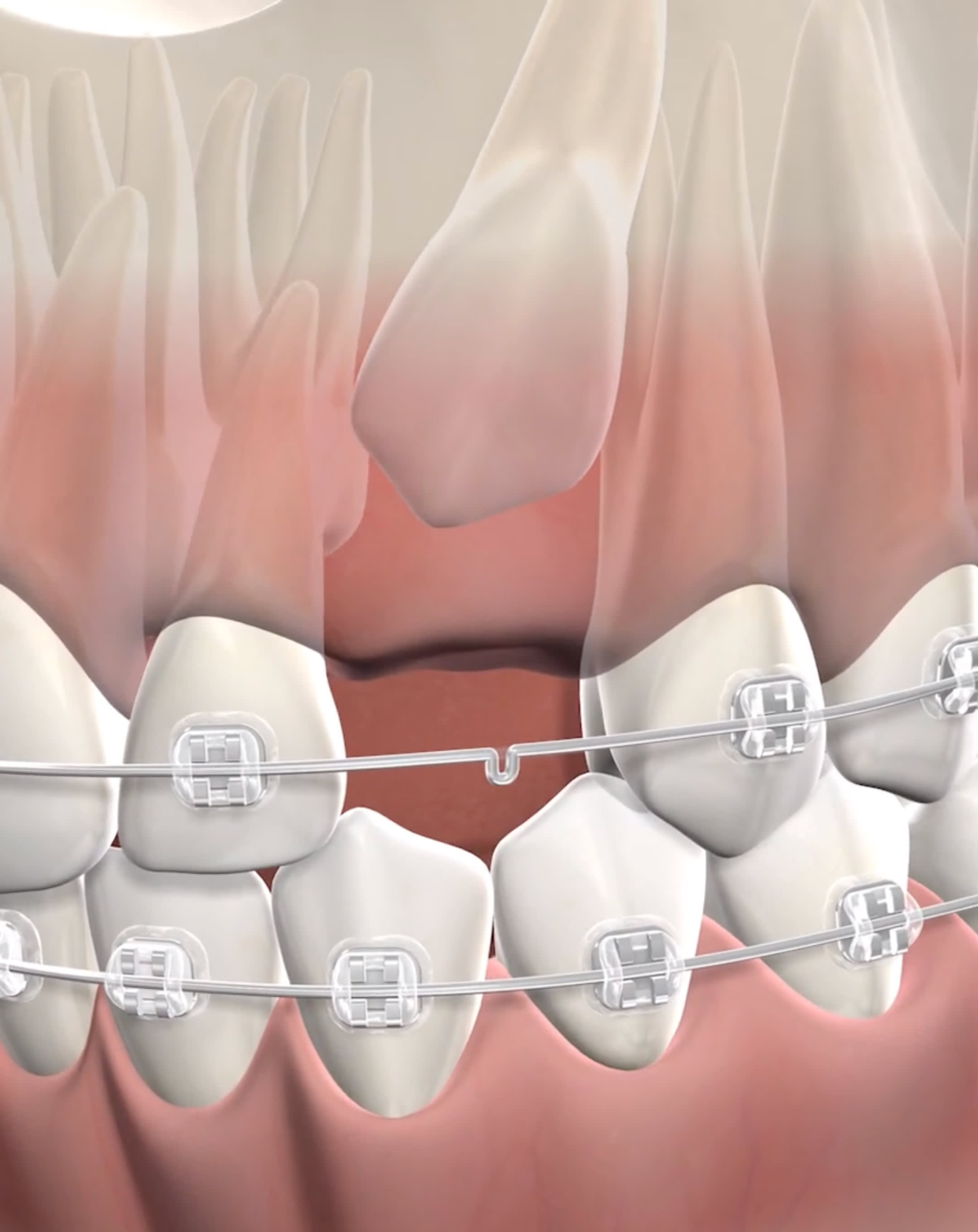 How impacted canines will be treated by one of our orthodontists.