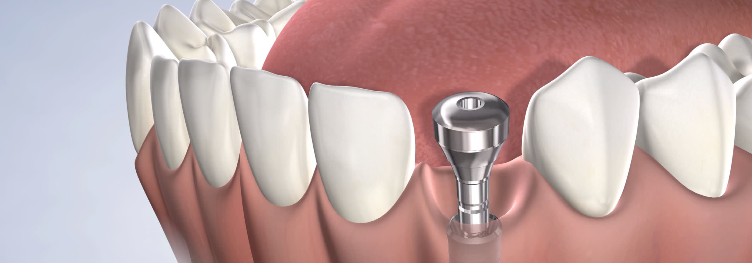 How to get quality dental implants in Aliso Viejo, CA.