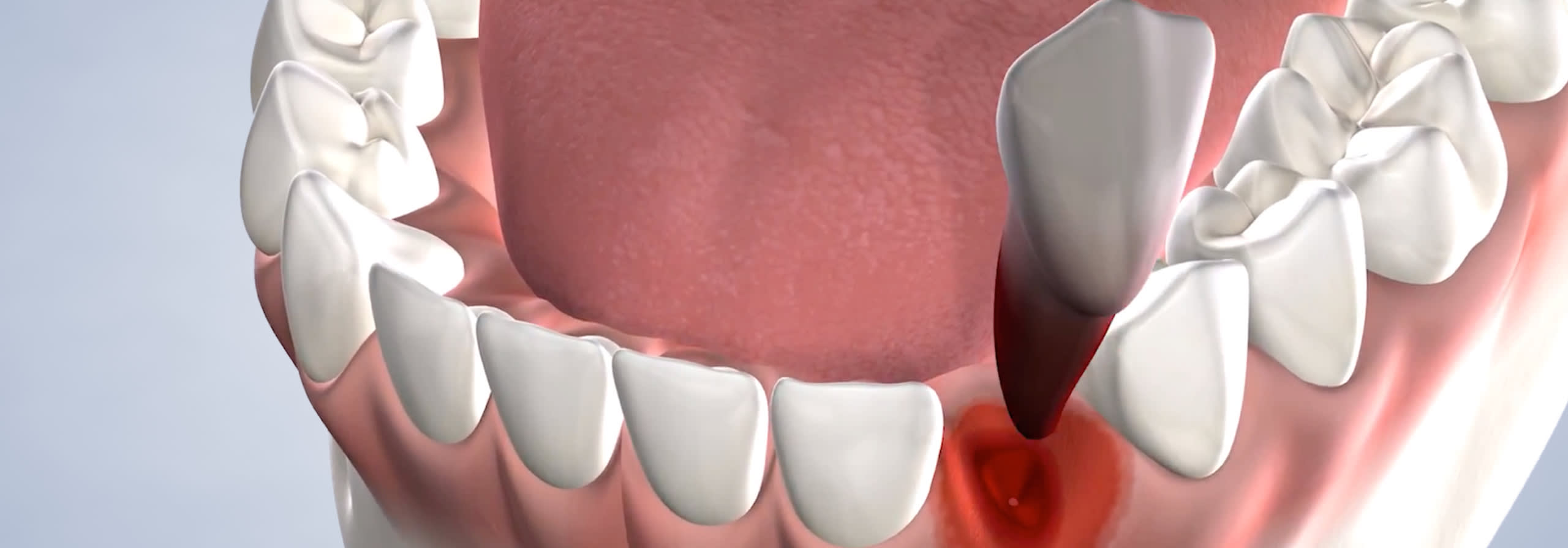 Tooth extraction procedure desktop