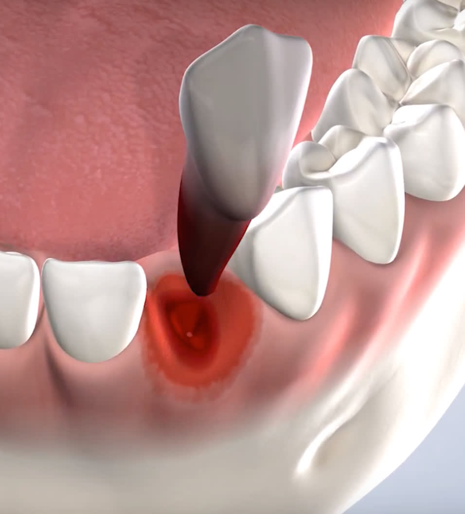 Tooth extraction procedure querypage