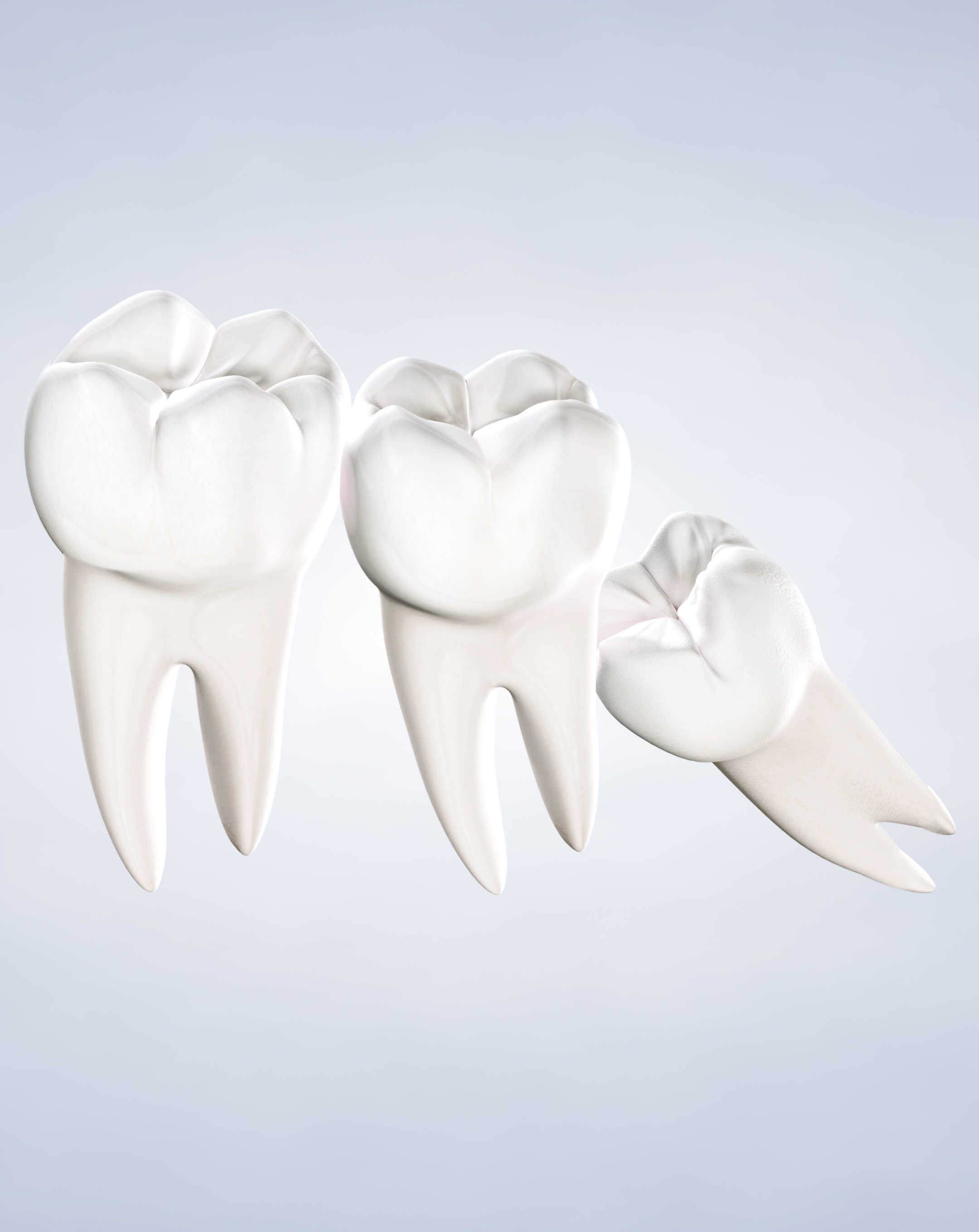 Wisdom teeth removal procedure mobile